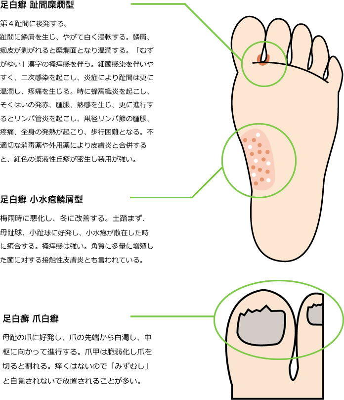 あし の うら が 痒い