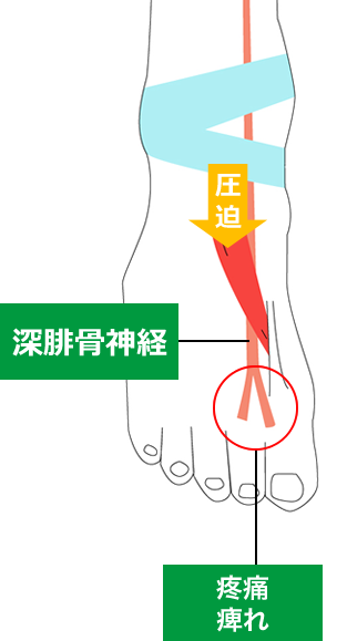 ⑪踵部脂肪褥炎