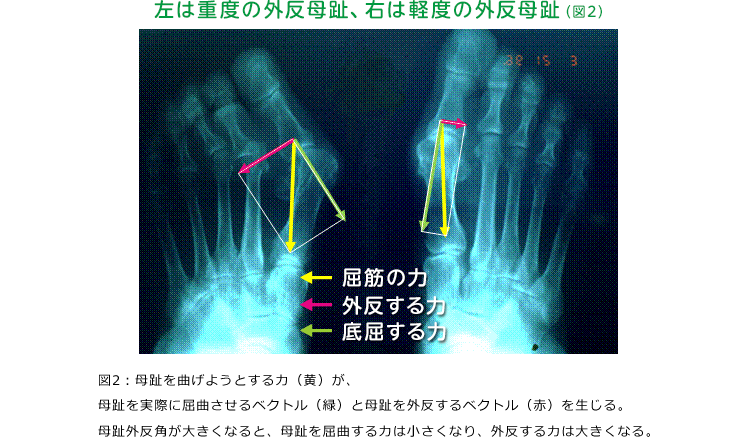 左は重度の外反母趾、右は軽度の外反母趾