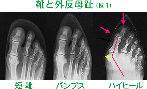 靴と外反母趾（図1）