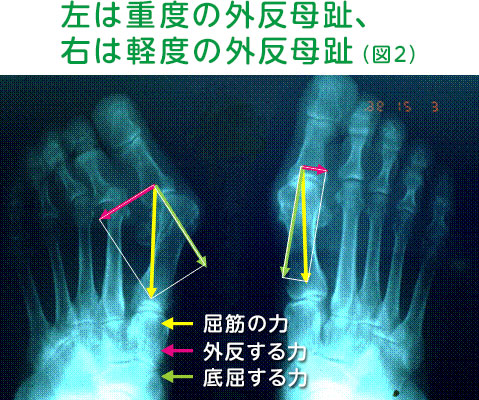 左は重度の外反母趾、右は軽度の外反母趾（図2）