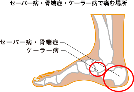 セーバー病・骨端症？