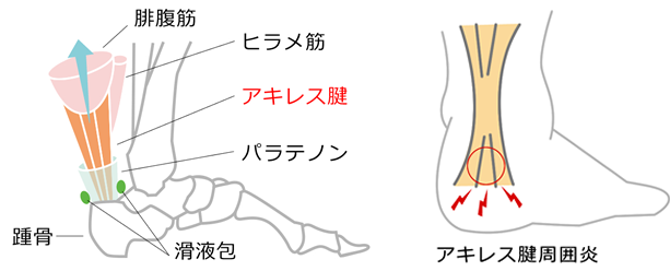 アキレス腱周囲炎