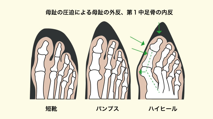 きっかけとなる母趾の外反