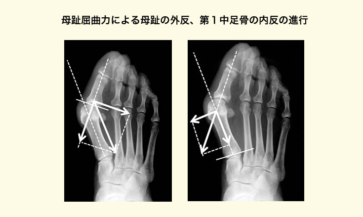 きっかけとなる母趾の外反