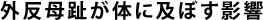 外反母趾が体に及ぼす影響