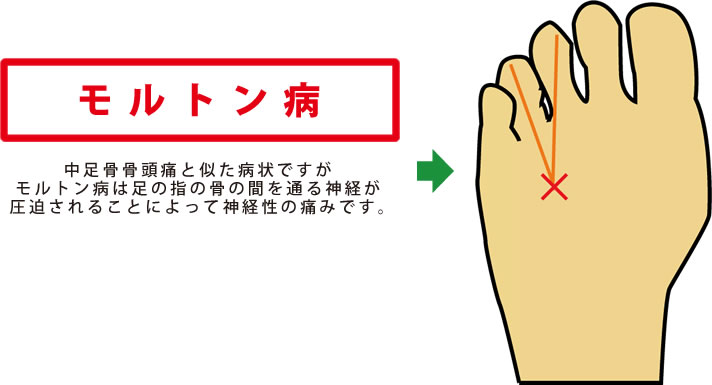 ウォーキングのリスクについて