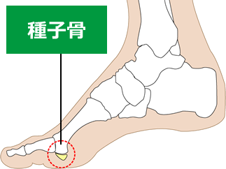 ④種子骨障害