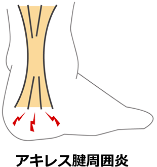 ⑫アキレス腱周囲（付着部）炎