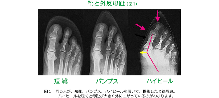 靴と外反母趾