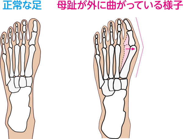 正常な足 母趾が外に曲がっている様子