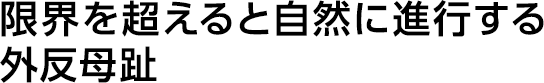 限界を超えると自然に進行する外反母趾