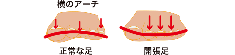 横のアーチ　正常な足　開帳足