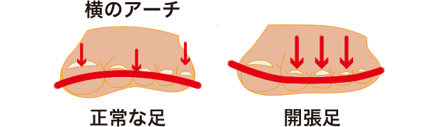 横のアーチ　正常な足　開帳足