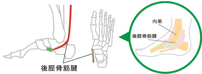 後脛骨筋腱機能不全（PTTD）