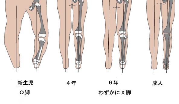 O脚とX脚