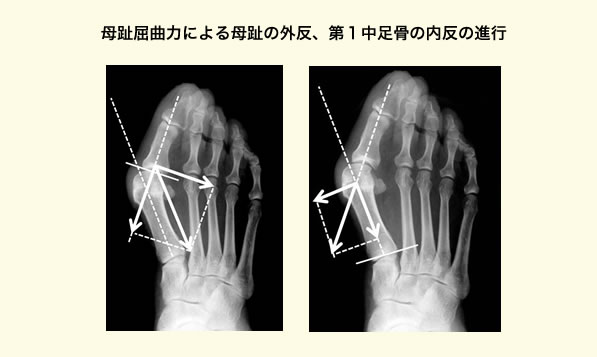 きっかけとなる母趾の外反