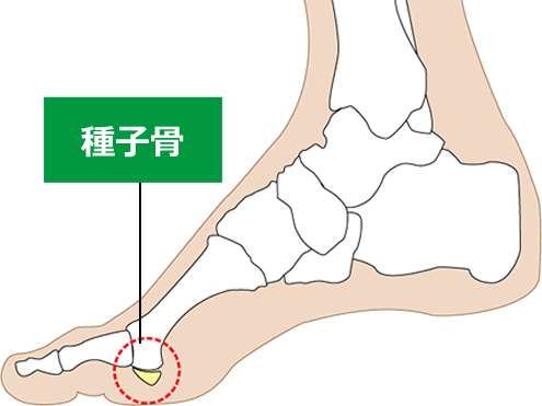 ④種子骨障害