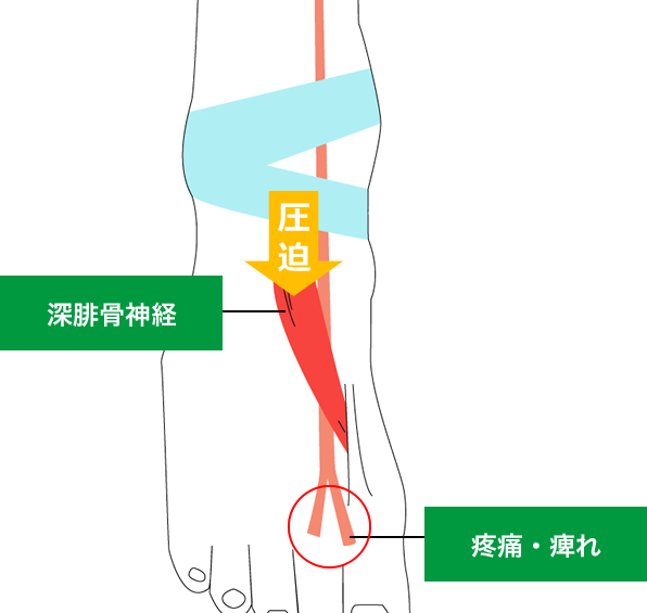 ⑦前足根管症候群