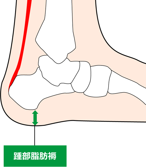 ⑩足底腱膜炎