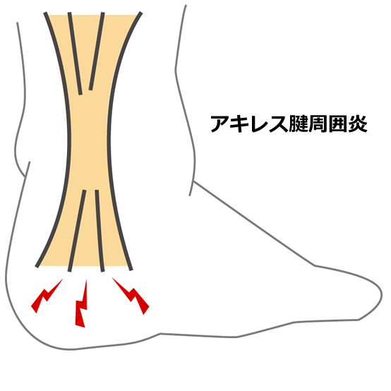 ⑫アキレス腱周囲（付着部）炎