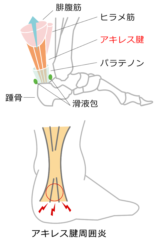 アキレス腱周囲炎