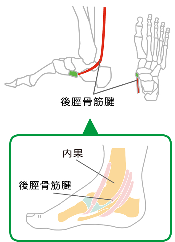 後脛骨筋腱機能不全（PTTD