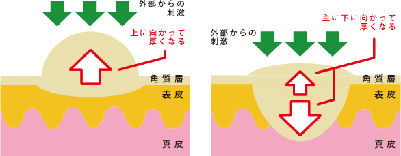 アキレス腱周囲炎