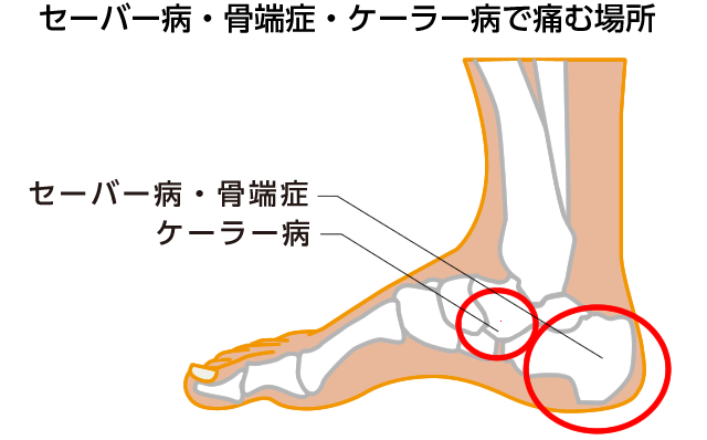 セーバー病・ケーラー病で痛む場所